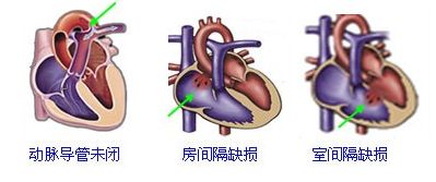 小儿室间隔缺损