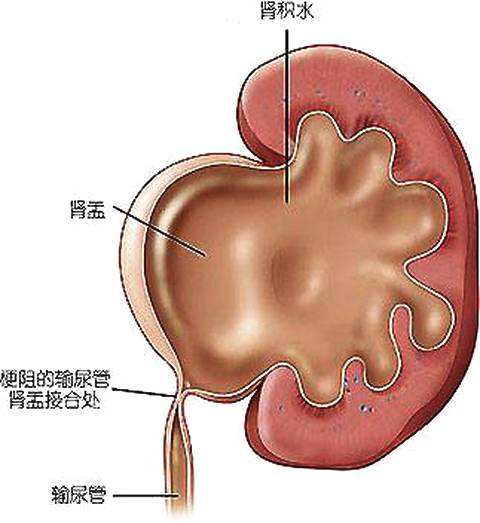 小儿肾积水