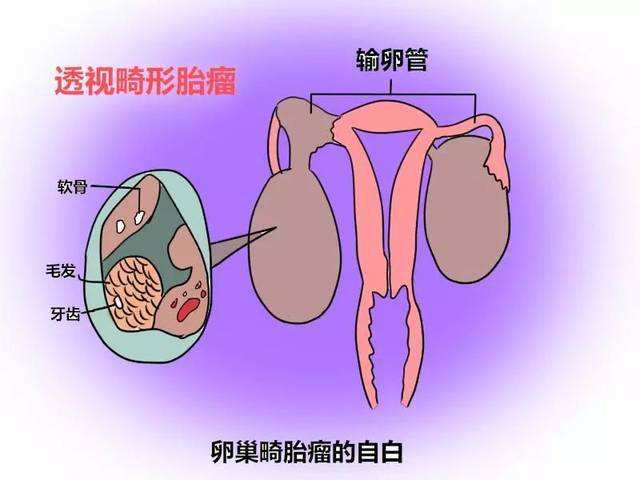 卵巢畸胎瘤