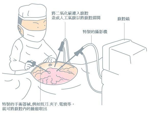 腹腔镜手术