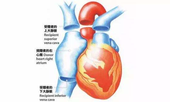 心脏移植