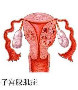 子宫腺肌症