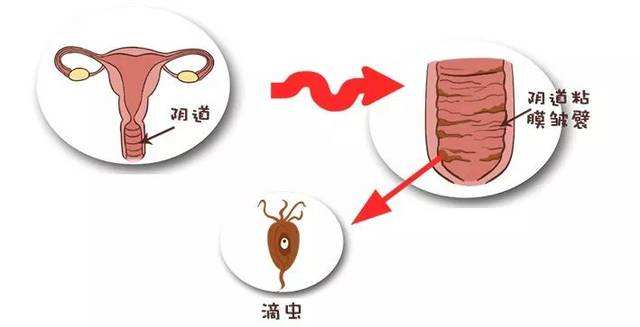 滴虫性阴道炎