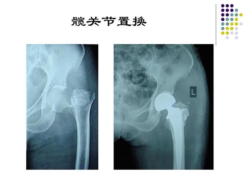 髋关节置换术